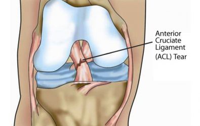 ACL rupture_tear