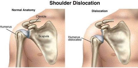 Shoulder stabilisation surgery