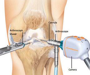 knee arthroscopy