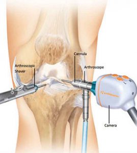 knee-arthroscopy